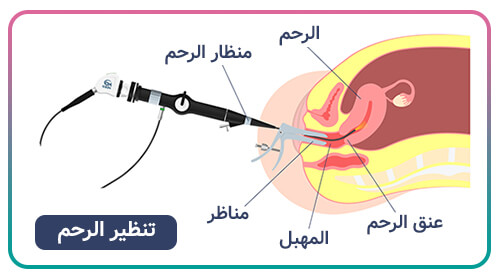 /منظار رحم